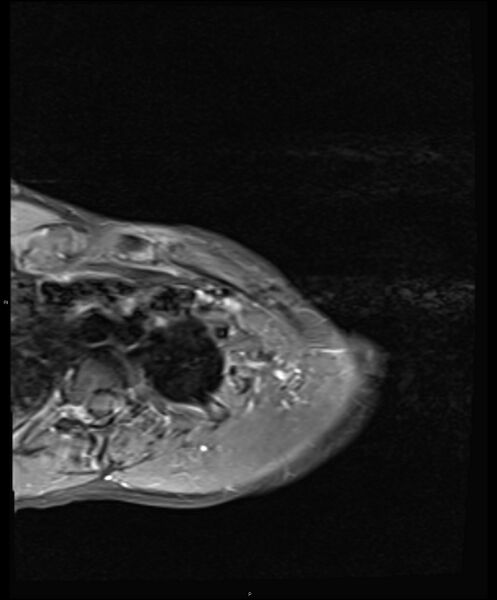 File:Chronic reactive multifocal osteomyelitis (CRMO) - clavicle (Radiopaedia 56406-63114 Axial T1 C+ fat sat 6).jpg