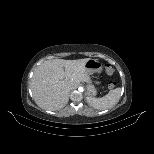 File:Chronic thromboembolic pulmonary hypertension (CTEPH) (Radiopaedia 74597-85532 Axial C+ CTPA 1).jpg