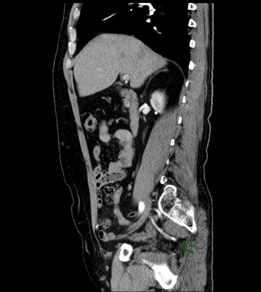 File:Clear cell renal cell carcinoma (Radiopaedia 85006-100539 E 39).jpg
