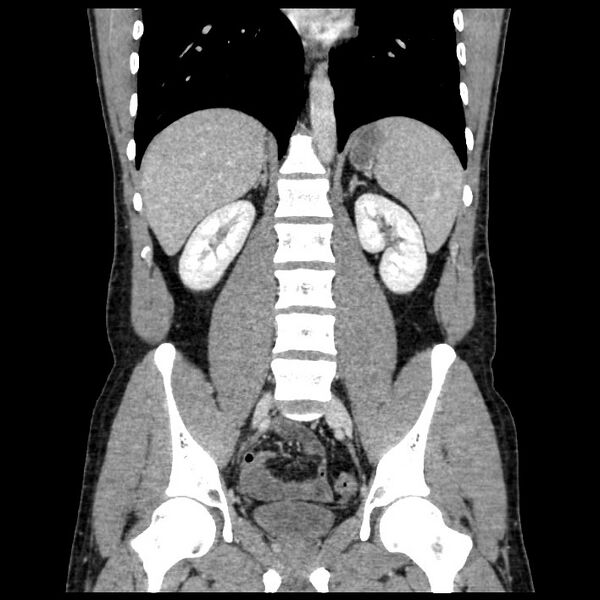 File:Co-existing acute appendicitis and epiploic appendagitis (Radiopaedia 61789-69911 C 42).jpg