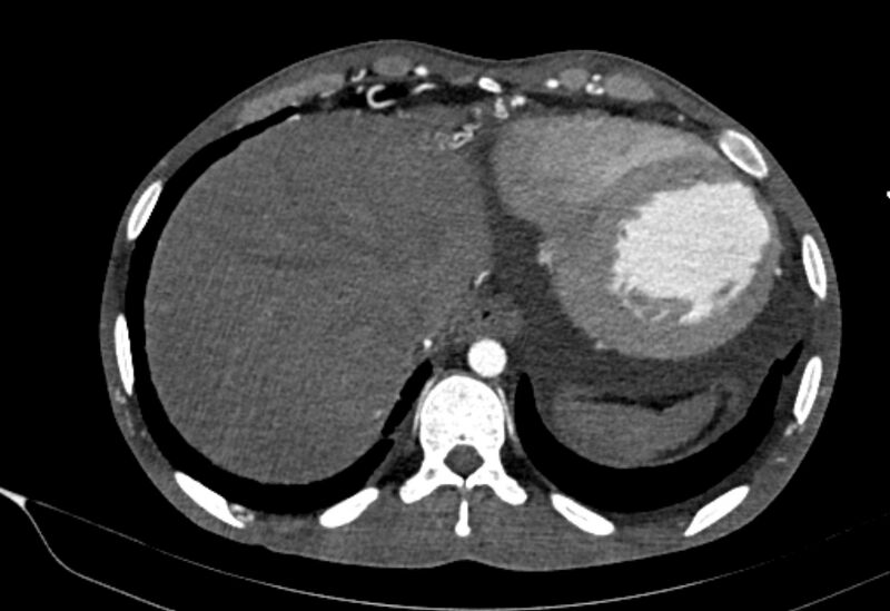 File:Coarctation of aorta with aortic valve stenosis (Radiopaedia 70463-80574 A 201).jpg