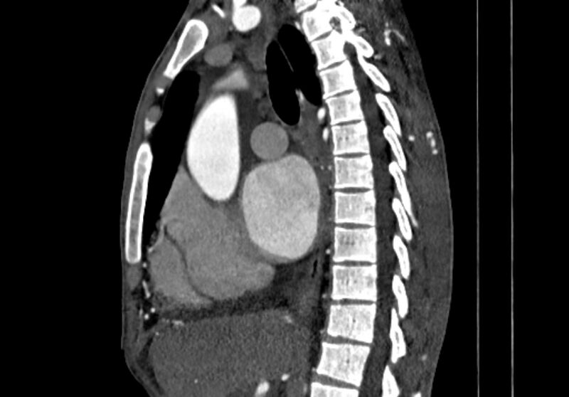 File:Coarctation of aorta with aortic valve stenosis (Radiopaedia 70463-80574 B 44).jpg