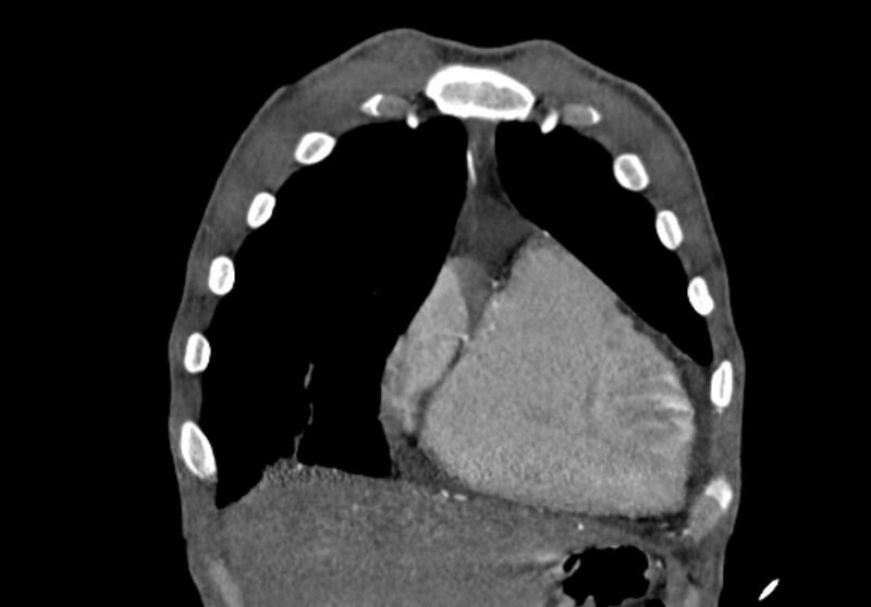 File:Coarctation of aorta with aortic valve stenosis (Radiopaedia 70463-80574 C 27).jpg