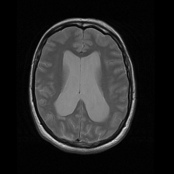 File:Colloid cyst with hydrocephalus (Radiopaedia 9373-10065 Axial PD 12).jpg