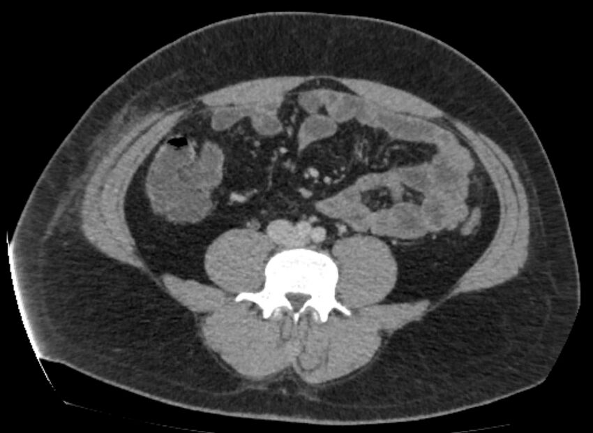 Colocutaneous fistula (Radiopaedia 56401-63062 A 53).jpg