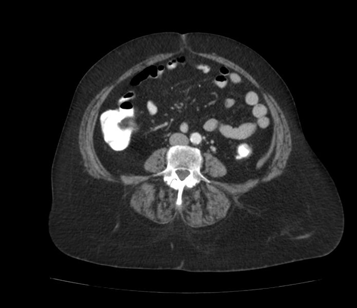 File:Colonic diverticulosis (Radiopaedia 22934-22957 A 42).jpg