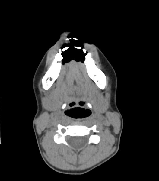 File:Nasoorbitoethmoid fracture (Radiopaedia 90044-107205 Axial non-contrast 56).jpg