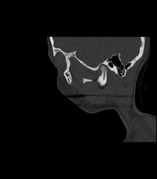 File:Nasoorbitoethmoid fracture (Radiopaedia 90044-107205 Sagittal bone window 116).jpg
