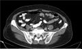 Necrotizing pancreatitis (Radiopaedia 20595-20495 A 33).jpg