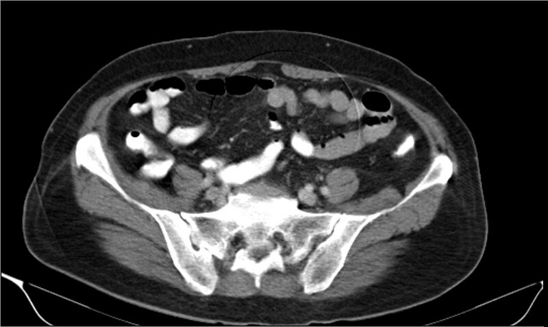 File:Necrotizing pancreatitis (Radiopaedia 20595-20495 A 33).jpg
