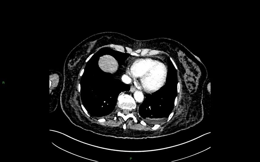 Neo-terminal ileal stricture (Crohn disease) (Radiopaedia 33790-34948 A 11).jpg