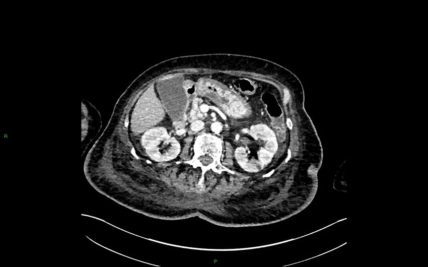 Neo-terminal ileal stricture (Crohn disease) (Radiopaedia 33790-34948 A 164).jpg