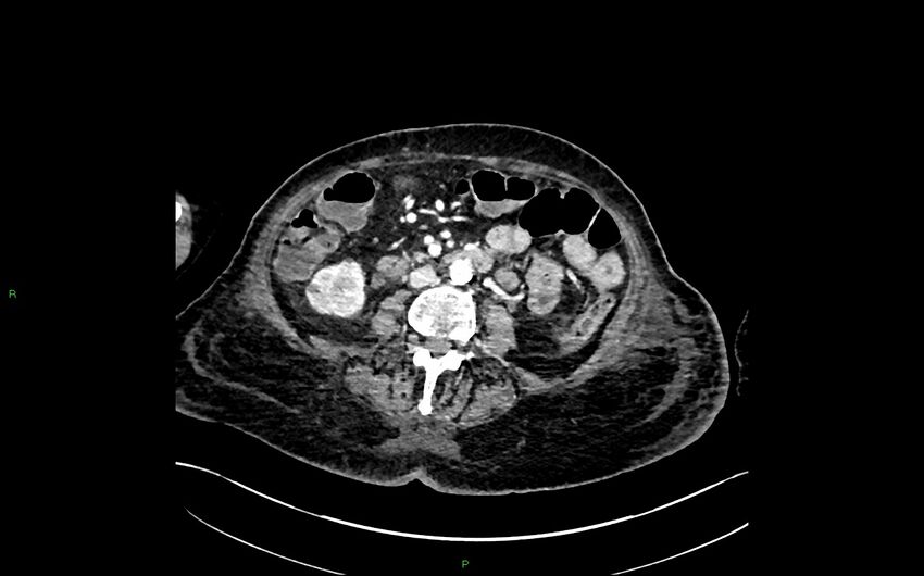 Neo-terminal ileal stricture (Crohn disease) (Radiopaedia 33790-34948 A 219).jpg
