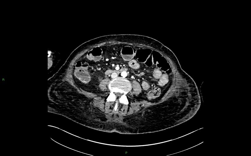 Neo-terminal ileal stricture (Crohn disease) (Radiopaedia 33790-34948 A 241).jpg