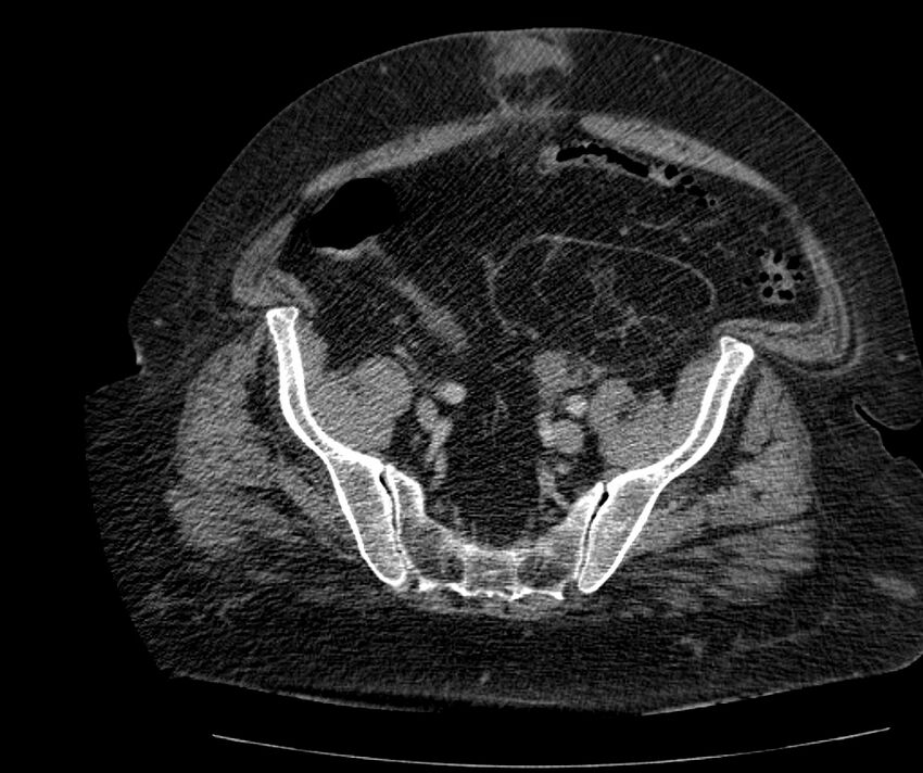 Nephroptosis with inguinal hernia containing perirenal fat (Radiopaedia 56632-63391 C 270).jpg