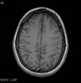 Neurosarcoidosis (Radiopaedia 10930-17204 Axial T1 15).jpg