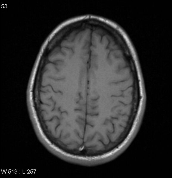 File:Neurosarcoidosis (Radiopaedia 10930-17204 Axial T1 15).jpg