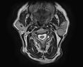 Non-Hodgkin lymphoma - parotid gland (Radiopaedia 71531-81890 Axial T2 11).jpg