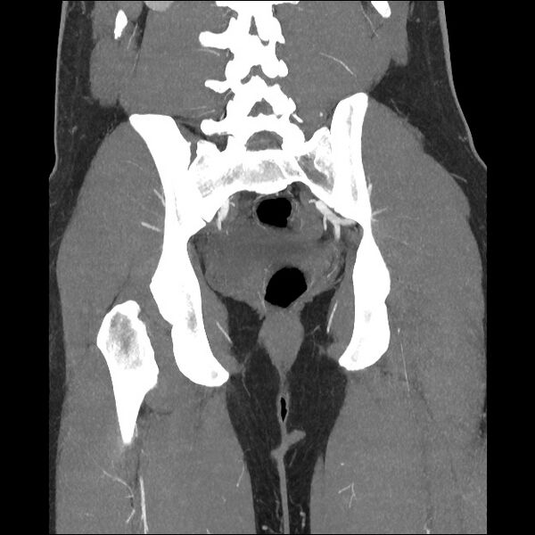 File:Normal CT angiogram of pelvis (Radiopaedia 45390-49430 B 32).jpg