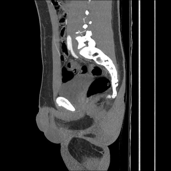 File:Normal CT angiogram of pelvis (Radiopaedia 45390-49430 C 40).jpg