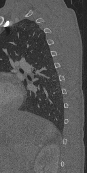 File:Normal CT thoracic spine (Radiopaedia 40181-42688 Sagittal bone window 4).png