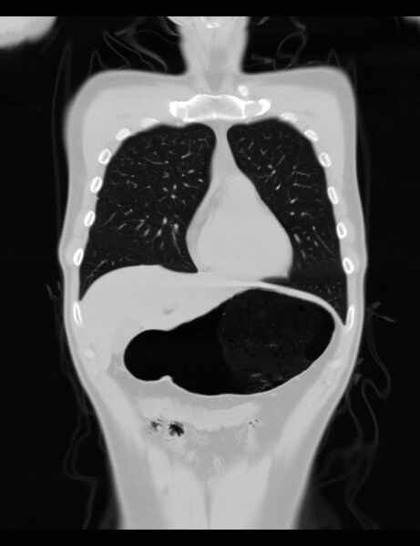 File:Normal CT virtual gastroscopy (Radiopaedia 29960-30501 F 17).jpg
