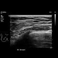 Normal breast mammography (tomosynthesis) and ultrasound (Radiopaedia 65325-74354 Right breast 3).jpeg