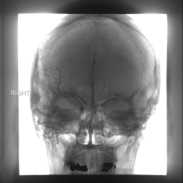 File:Normal cerebral angiogram (four vessel DSA) (Radiopaedia 41708-44649 RT ICA Ref 1).png