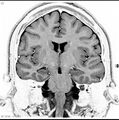 Normal coronal brain (Radiopaedia 6676-7910 B 22).jpg