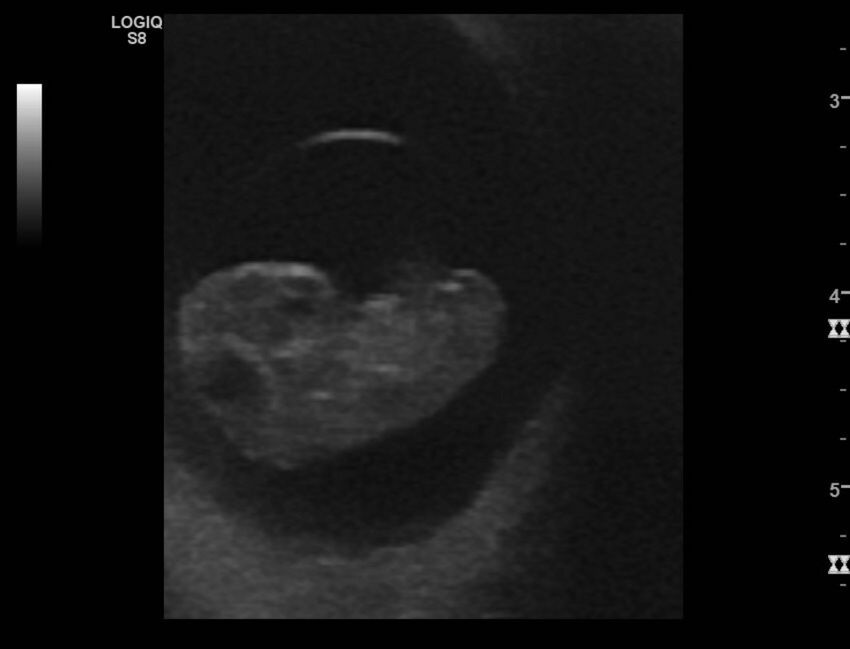 Normal early pregnancy - 8w0d (Radiopaedia 44715-48492 Longitudinal 16).jpg