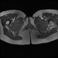 Normal female pelvis MRI (retroverted uterus) (Radiopaedia 61832-69933 Axial T1 31).jpg