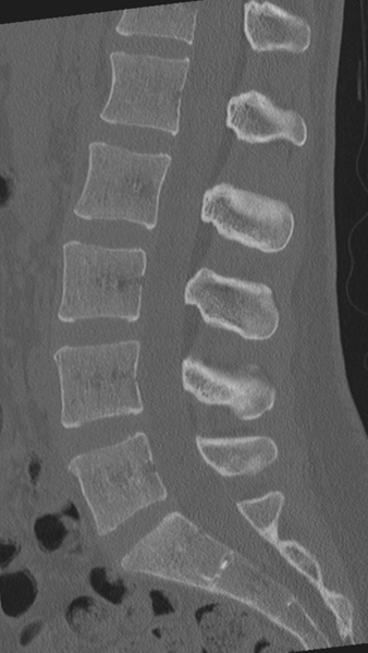 File:Normal lumbar spine CT (Radiopaedia 46533-50986 Sagittal bone window 52).png