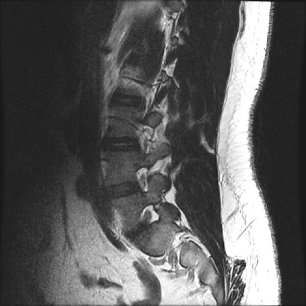 File:Normal lumbar spine MRI (Radiopaedia 43051-46311 Sagittal T2 16).jpg