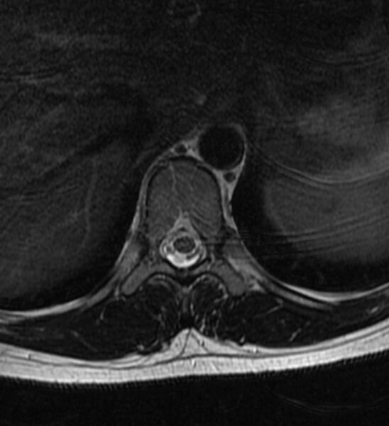 File:Normal thoracic spine MRI (Radiopaedia 41033-43781 Axial T2 16).jpg