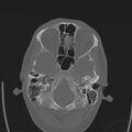 Obstructive hydrocephalus (Radiopaedia 30453-31119 Axial bone window 26).jpg