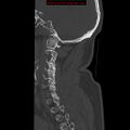 Occipital condyle fracture (Radiopaedia 18366-18208 Sagittal bone window 28).jpg