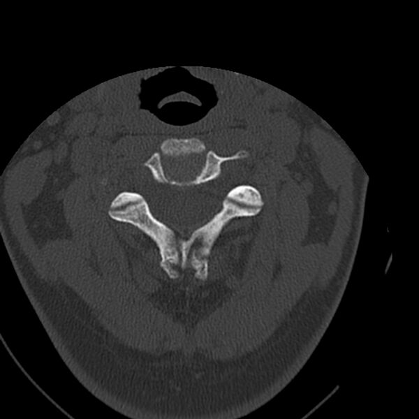 File:Occipital condyle fracture (Radiopaedia 31755-32691 Axial bone window 27).jpg