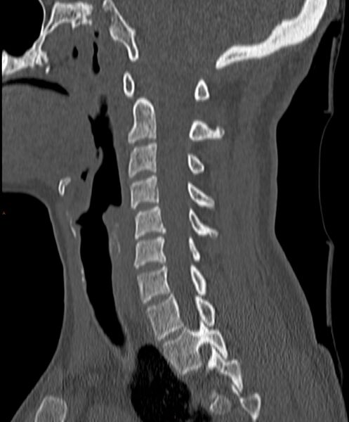 File:Occipital condyle fracture (Radiopaedia 61165-69056 Sagittal bone window 13).jpg
