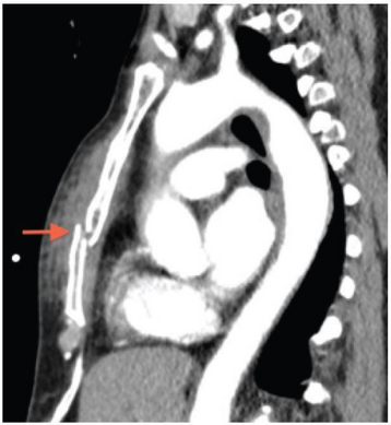 Computed tomography identifying displaced sternal fracture.