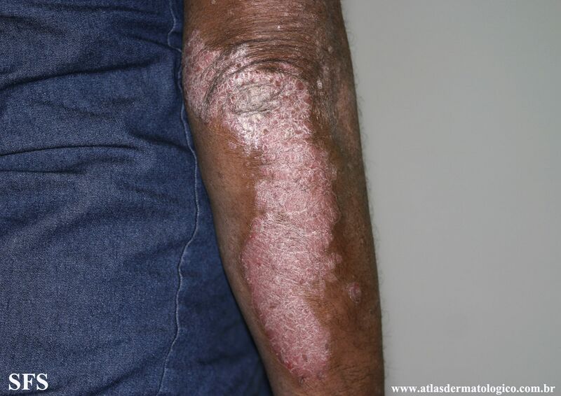 File:Psoriasis (Dermatology Atlas 100).jpg