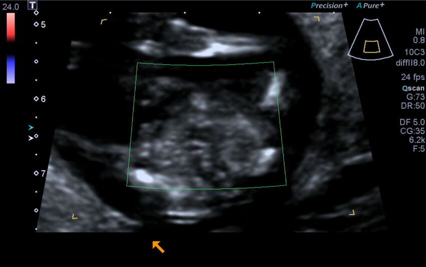 1st trimester nuchal-morphology ultrasound (Radiopaedia 44706-48477 Heart views cine with colour 198).jpg