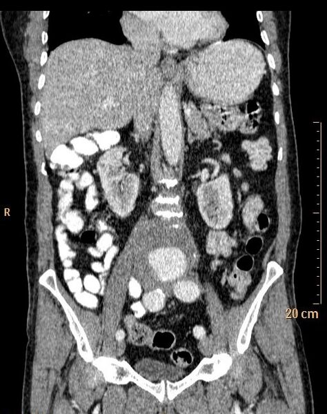 File:Abdominal aortic aneurysm (Radiopaedia 25985-26121 Coronal C+ arterial phase 19).jpg