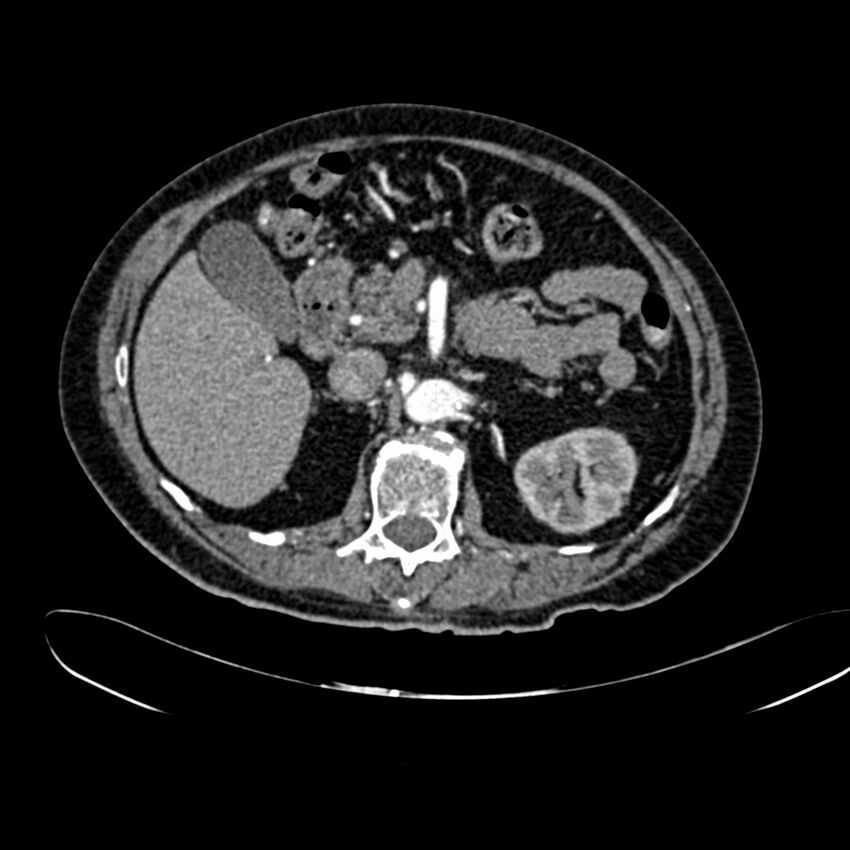Abdominal aortic aneurysm (Radiopaedia 75131-86203 Axial C+ arterial phase 16).jpg