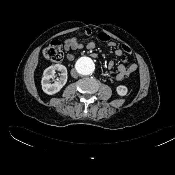 File:Abdominal aortic aneurysm (Radiopaedia 75131-86203 Axial C+ arterial phase 25).jpg