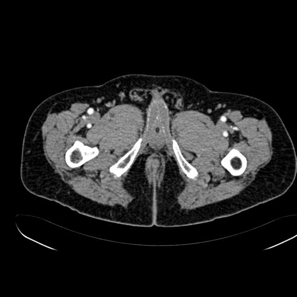 File:Abdominal aortic aneurysm (Radiopaedia 75131-86203 Axial C+ arterial phase 52).jpg