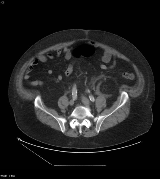 File:Abdominal aortic aneurysm with intramural hematoma then rupture (Radiopaedia 50278-55631 Axial C+ arterial phase 96).jpg