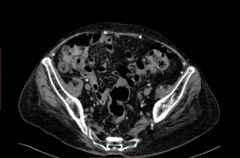 File:Abdominal aortic interposition tube graft and aneurysm thrombosis (Radiopaedia 71438-81857 Axial C+ arterial phase 184).jpg