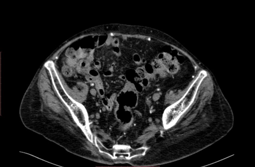 Abdominal aortic interposition tube graft and aneurysm thrombosis (Radiopaedia 71438-81857 Axial C+ arterial phase 184).jpg