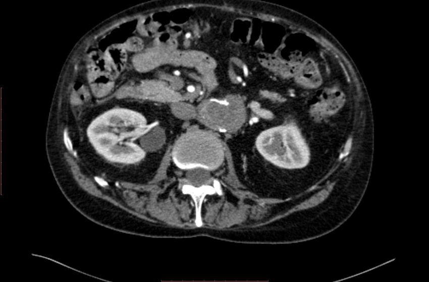Abdominal aortic interposition tube graft and aneurysm thrombosis (Radiopaedia 71438-81857 Axial C+ arterial phase 54).jpg