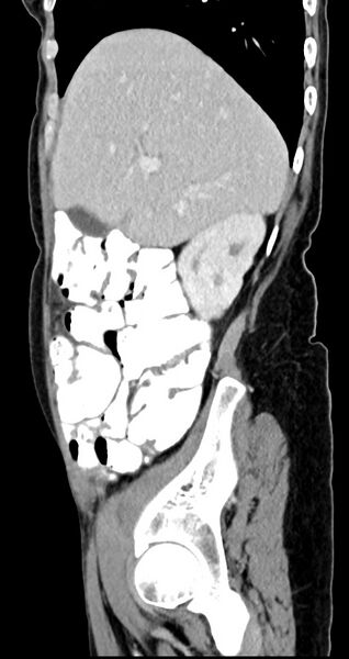 File:Abdominal wall and retroperitoneal tuberculosis (Radiopaedia 88137-104729 Sagittal C+ portal venous phase 113).jpg